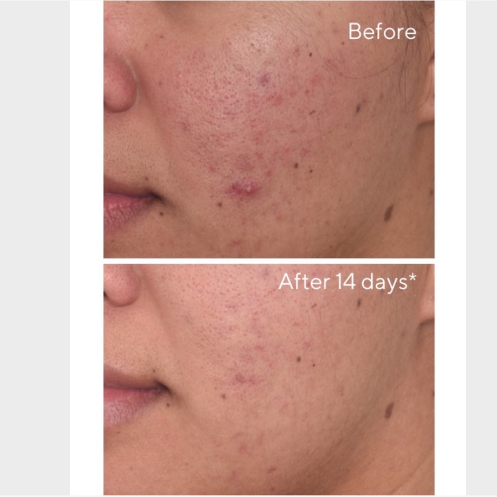 😊 NIB Murad Environmenral Sheild Rapid Dark Spot Correcting Serum 0.17 fl oz 😊 - Picture 5 of 7